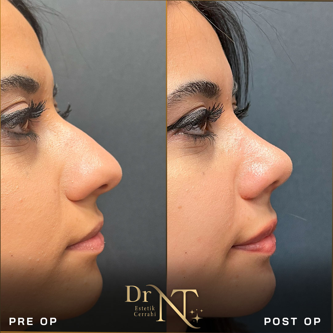 Rhinoplastik Galerie