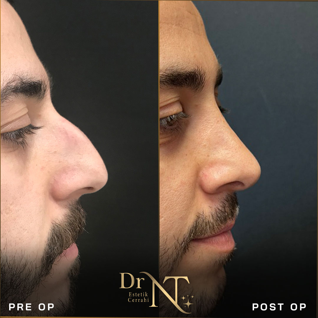 Rhinoplastik Galerie