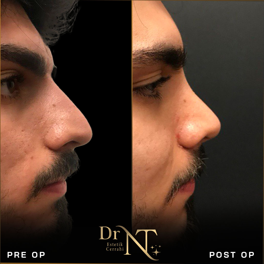 Rhinoplastik Galerie