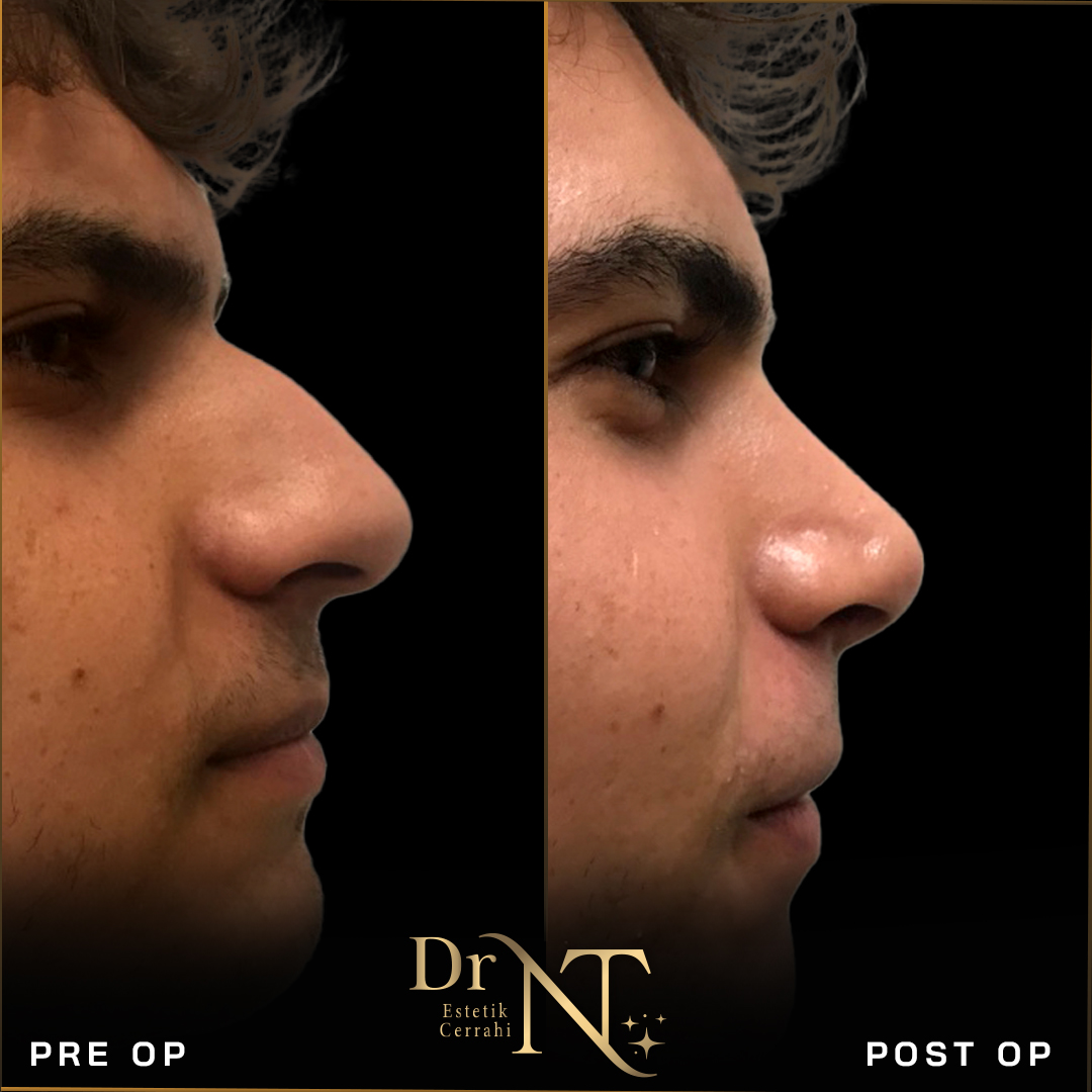 Rhinoplastik Galerie